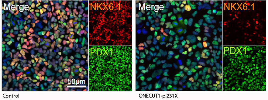 Mutationen in ONECUT1 stören Entwicklung der Bauchspeicheldrüse