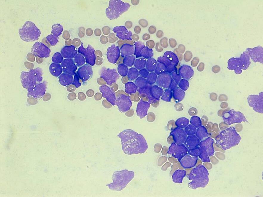 Mikro-RNAs hemmen Krebszellen bei Akuter Lymphoblastischer Leukämie