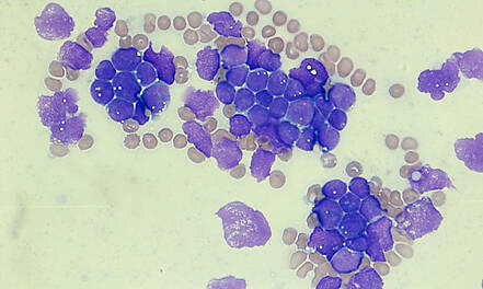 Mikro-RNAs hemmen Krebszellen bei Akuter Lymphoblastischer Leukämie