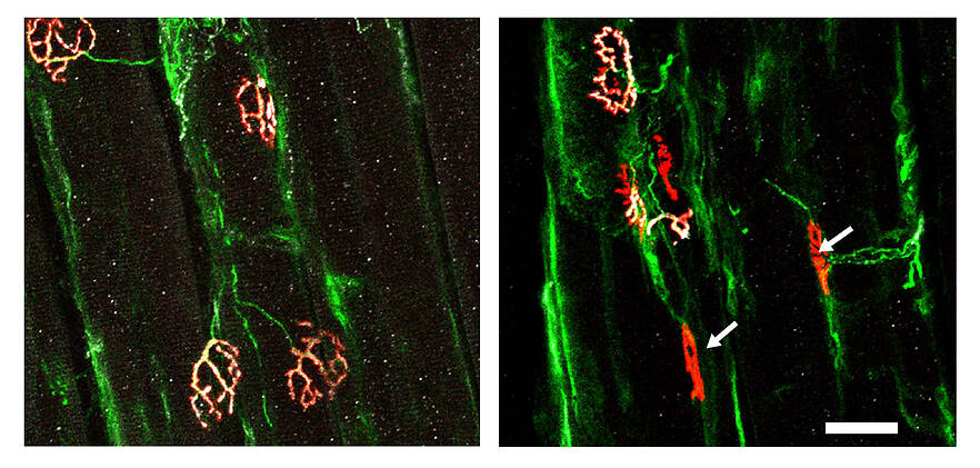 Eine Ulmer Studie zu ALS hat aufgedeckt, dass der Genregulator SRF Motoneurone, die für ALS anfällig sind, vor neurodegenerativen Effekten schützt